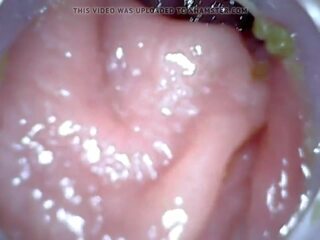 Anal endoscope parte 1, gratis enema castigo hd x calificación presilla 04